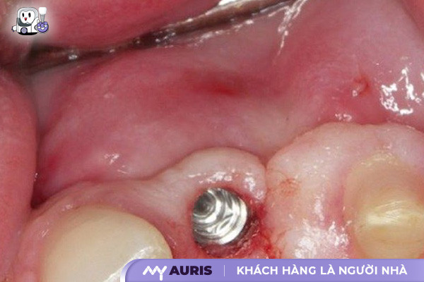 hối hận khi trồng implant