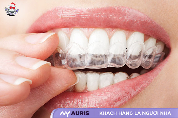 Chỉnh nha Invisalign