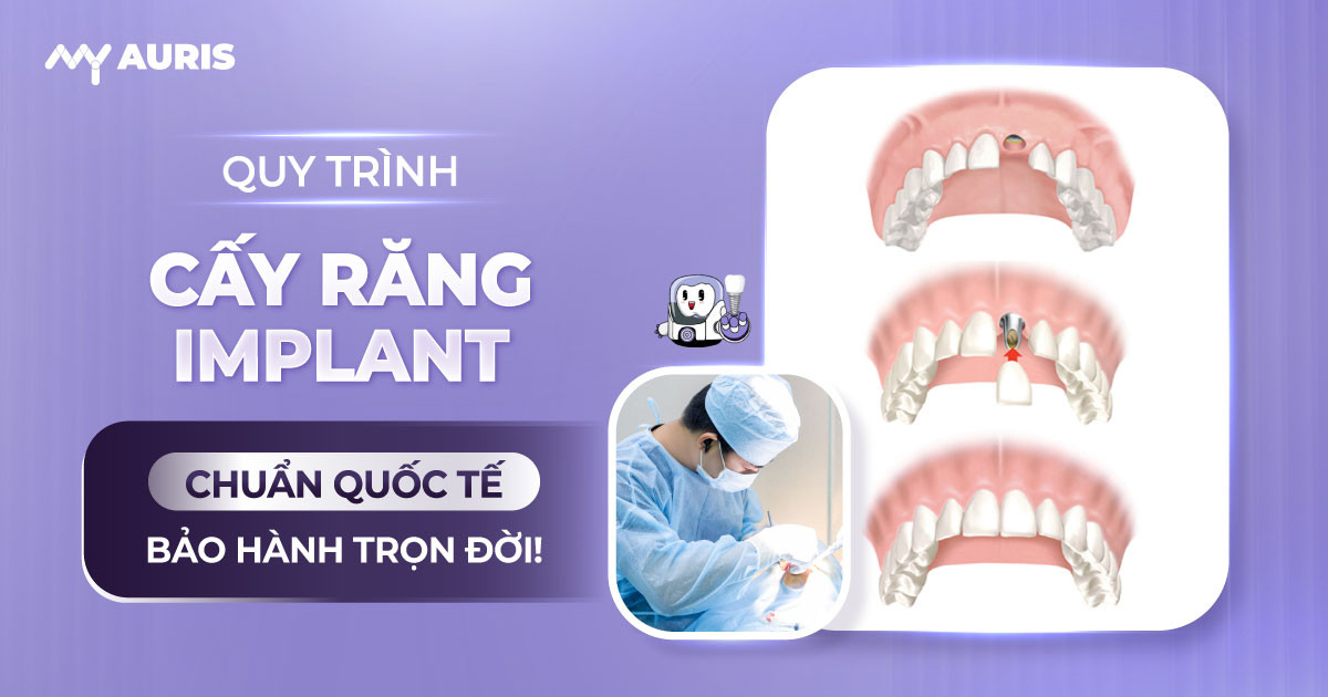 quy-trinh-cay-rang-implant