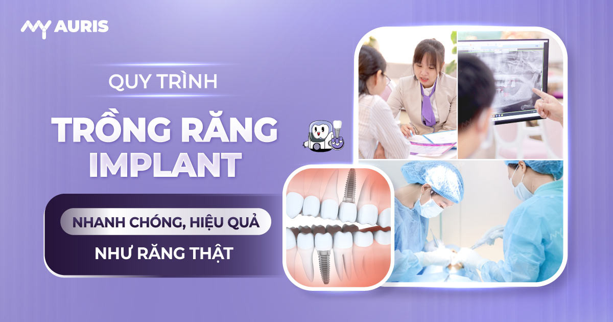 quyaquy trình trồng răng implant-trinh-trong-rang-implant-24-10-24