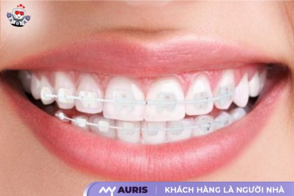 răng sứ cercon có mấy loại