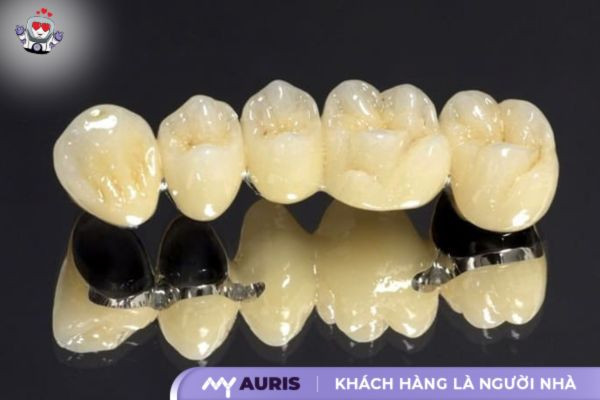 tác hại của răng sứ kim loại