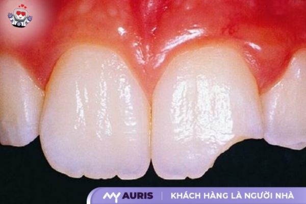 bọc răng sứ kim loại được bao lâu