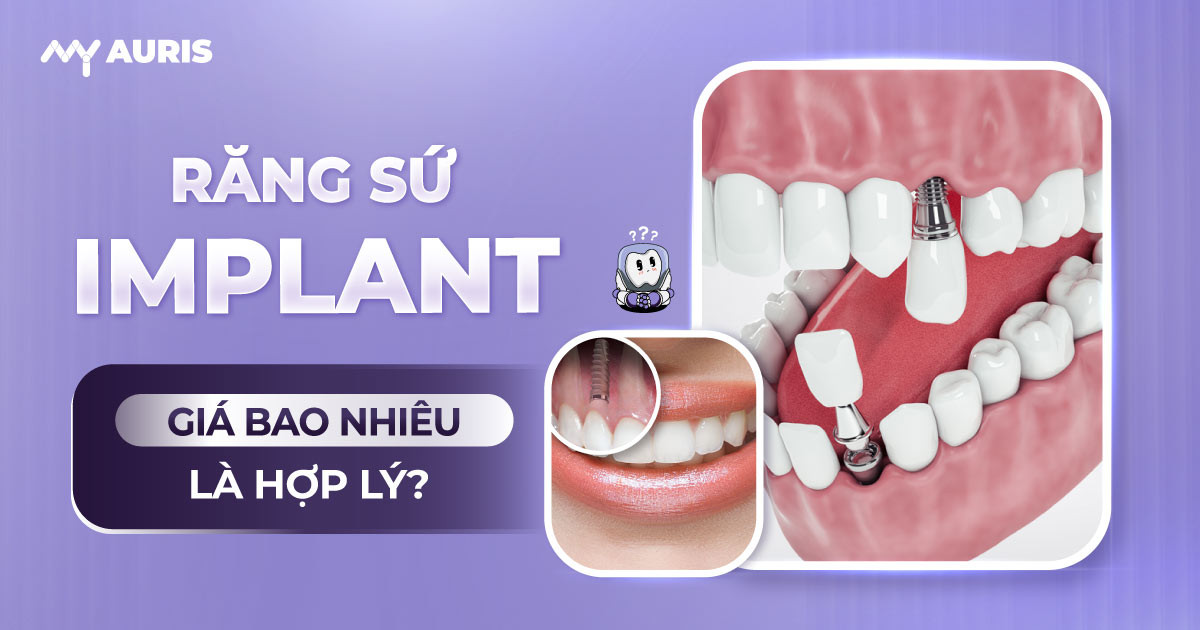 răng sứ implant