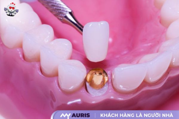 răng sứ kim loại có mấy loại