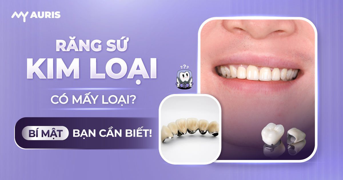 răng sứ kim loại có mấy loại