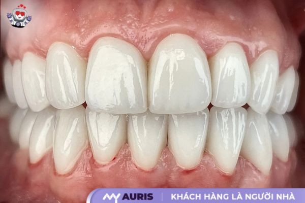 răng sứ lava là gì tìm hiểu ưu nhược điểm và loại phù hợp