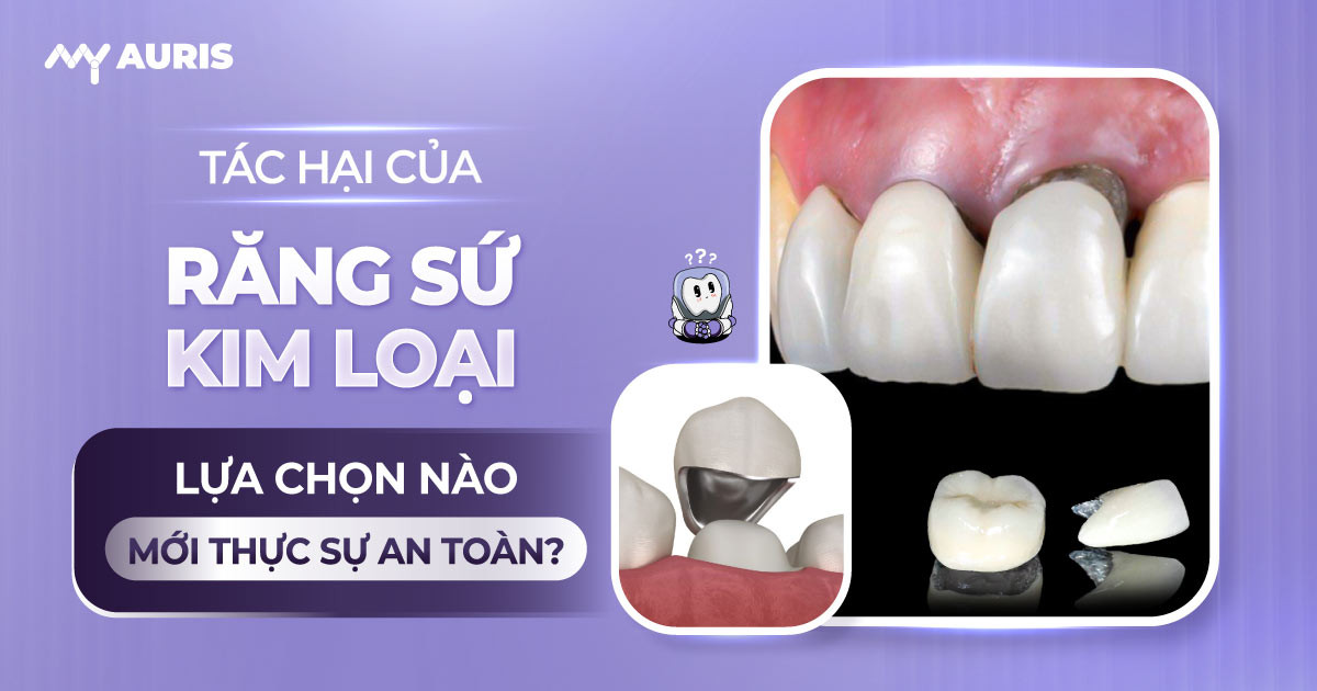 tác hại của răng sứ kim loại