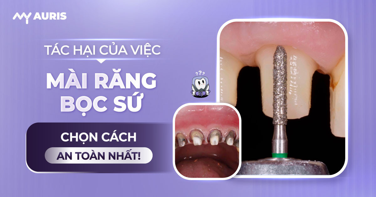 tác hại của việc mài răng bọc sứ