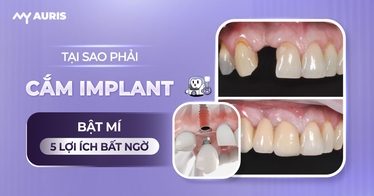 tại sao phải cắm implant