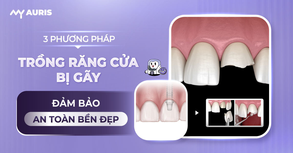 trồng răng cửa bị gãy