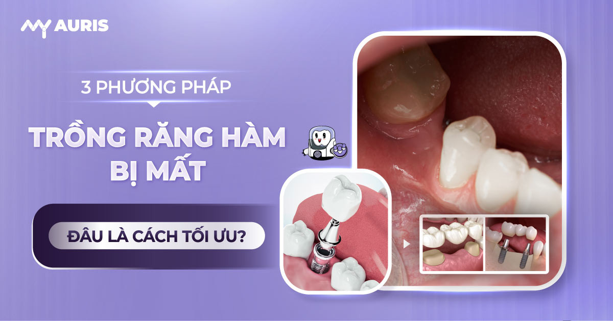 trồng răng hàm bị mất