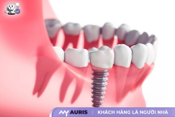 trong-rang-implant-2024-9