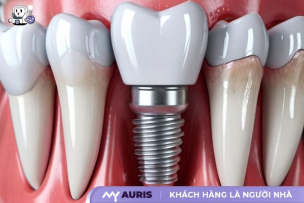 trong-rang-implant-22-10-2024-2