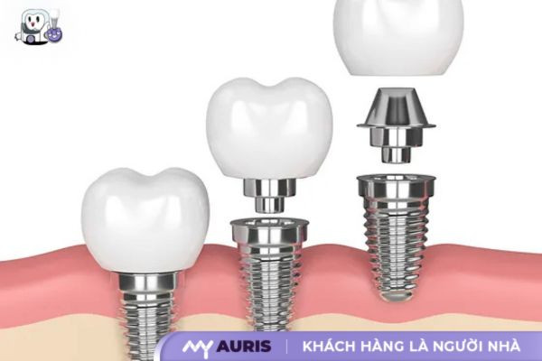 cham-soc-implant