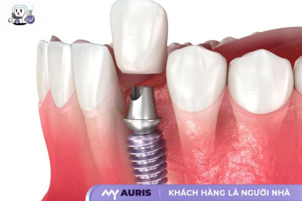 trong-rang-implant-22-10-2024