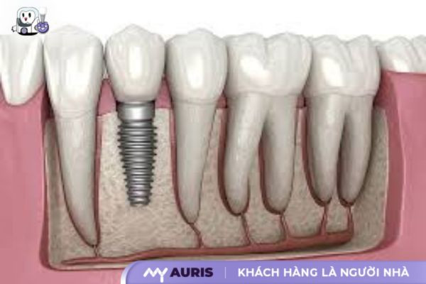 trong-rang-implant-23-10-2024