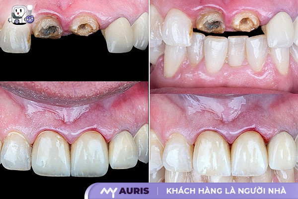 Trồng răng Implant có đau không