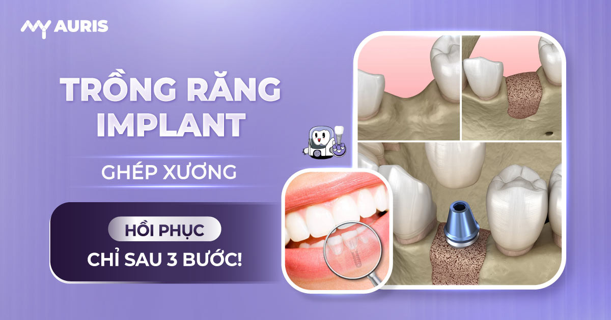 trồng răng implant ghép xương