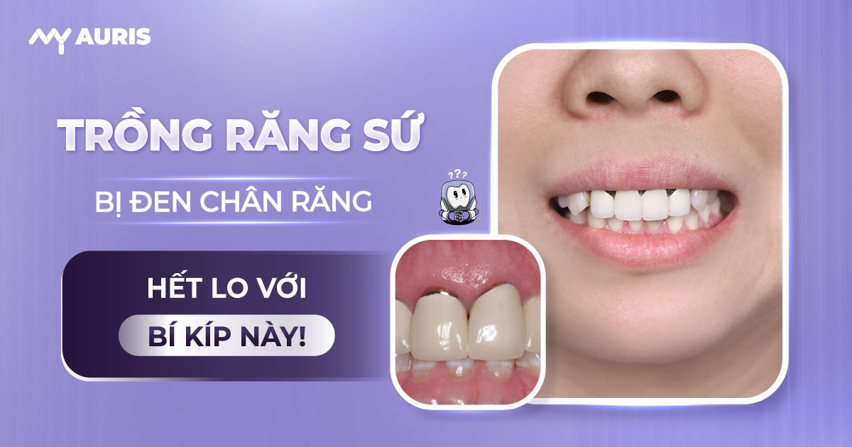 trồng răng sứ bị đen chân răng