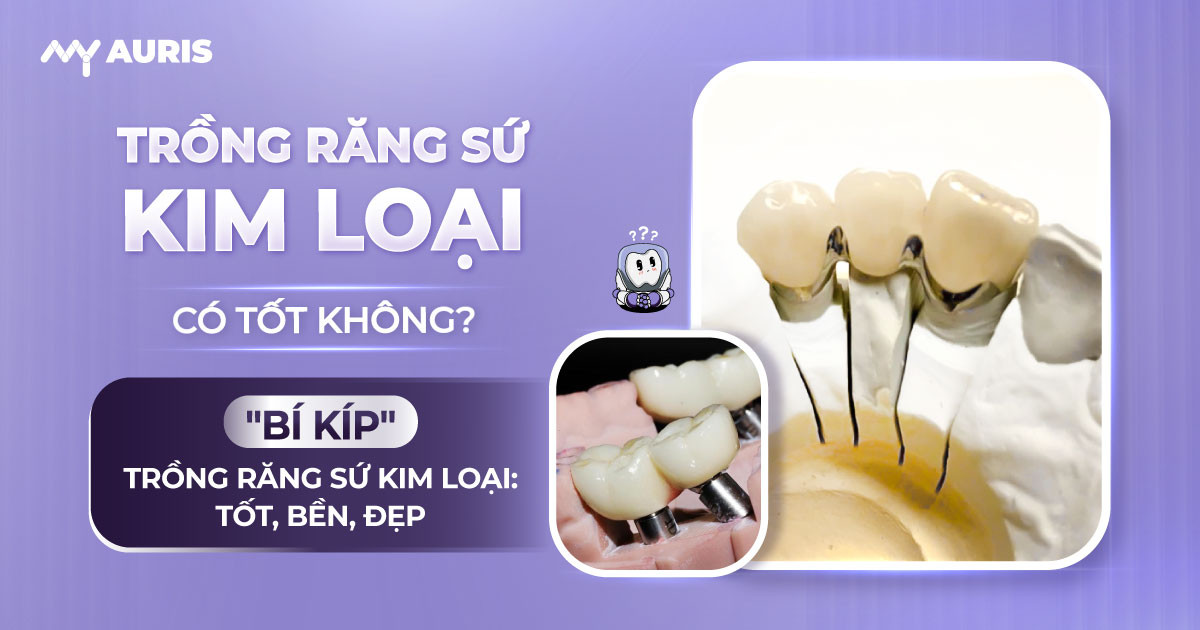 trong-rang-su-kim-loai-co-tot-khong-10-10-24