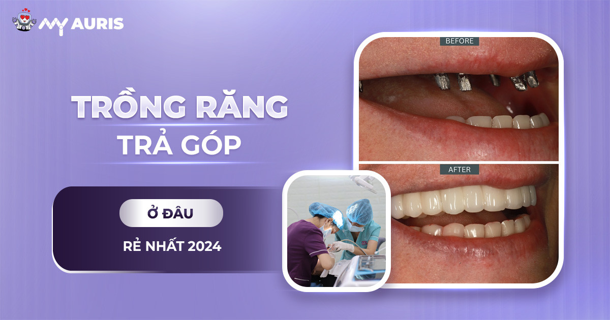 trong-rang-tra-gop-221024-05