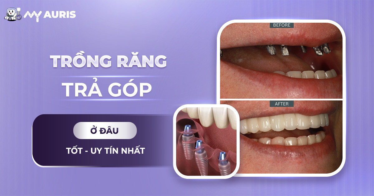 trồng răng trả góp