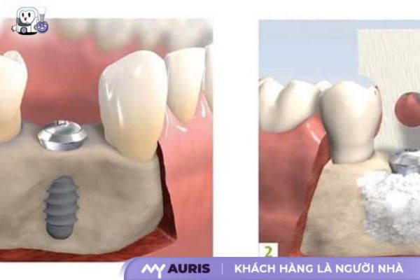 ghép xương trong cấy implant bao lâu