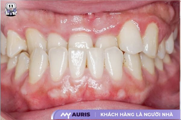 các trường hợp cần niềng răng