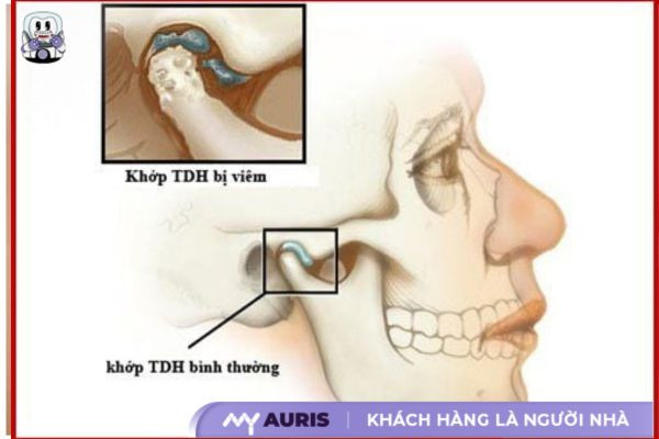 răng khấp khểnh nhẹ