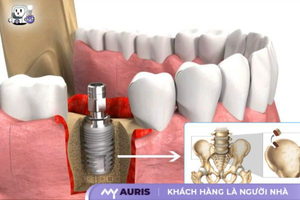 ghép xương trong cấy implant bao lâu