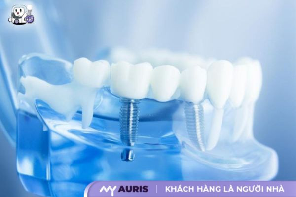 trồng răng implant có được bảo hiểm không