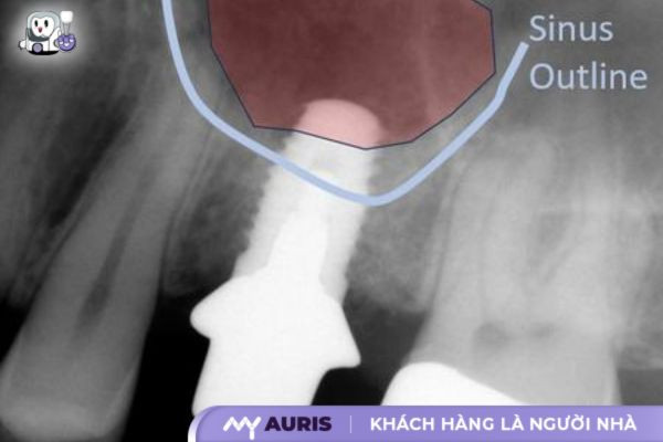 cắm implant bị lệch