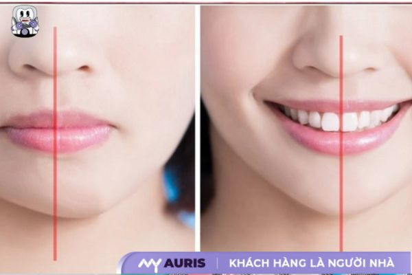 niềng răng lệch nhân trung
