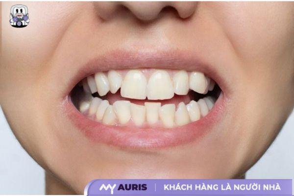 răng khấp khểnh hàm dưới