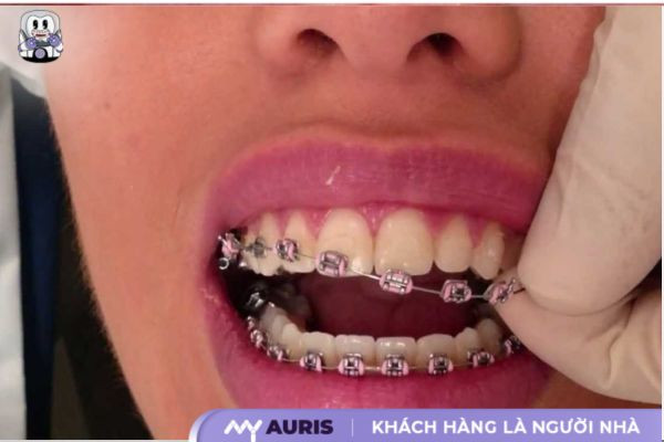 tháo niềng răng tạm thời