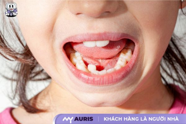 răng khấp khểnh hàm dưới