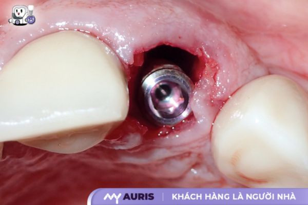 cấy ghép implant tức thì