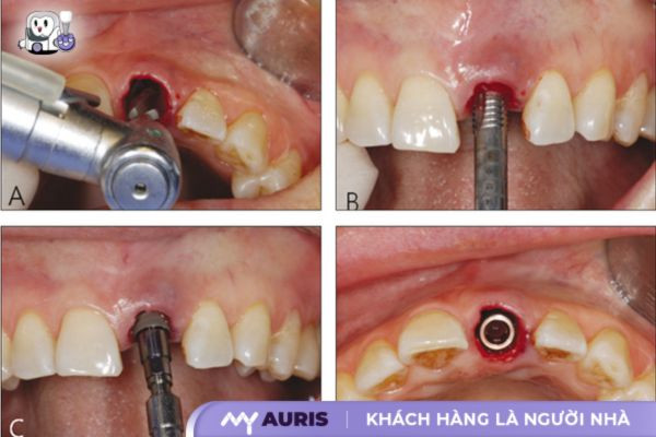 cấy ghép implant tức thì