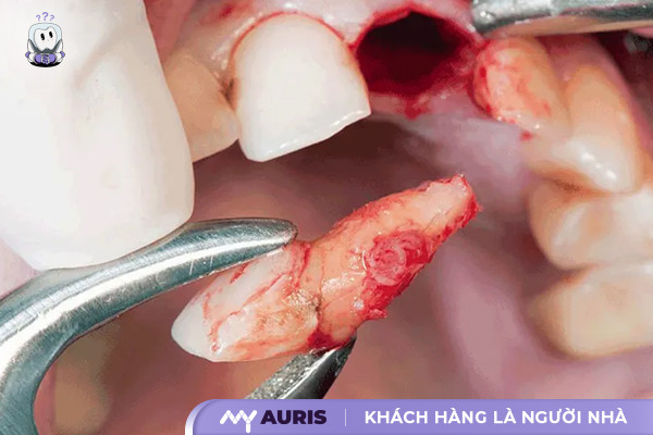 áp xe răng,áp xe răng là gì,áp xe răng khôn,áp xe răng uống thuốc gì