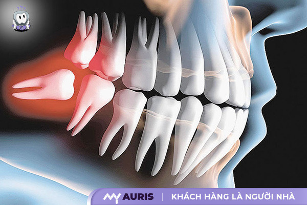 áp xe răng,áp xe răng là gì,áp xe răng khôn,áp xe răng uống thuốc gì