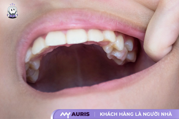 áp xe răng,áp xe răng là gì,áp xe răng khôn,áp xe răng uống thuốc gì