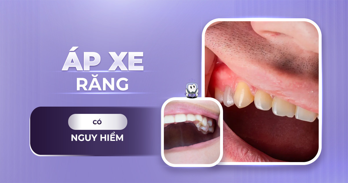 áp xe răng,áp xe răng là gì,áp xe răng khôn,áp xe răng uống thuốc gì