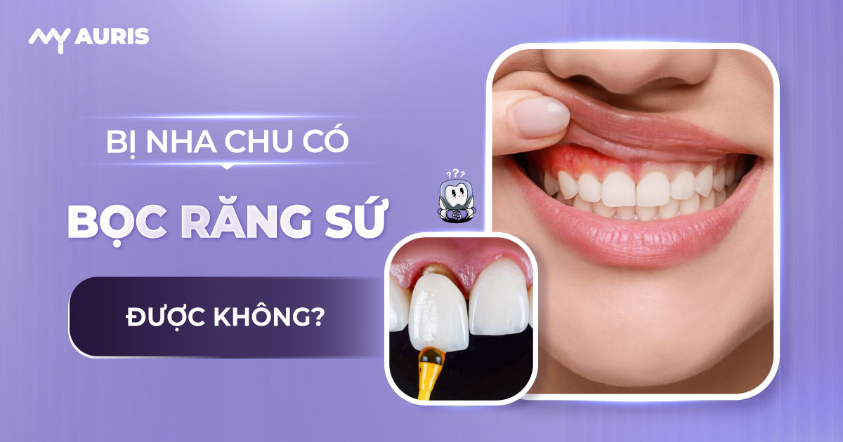 bị nha chu có bọc răng sứ được không