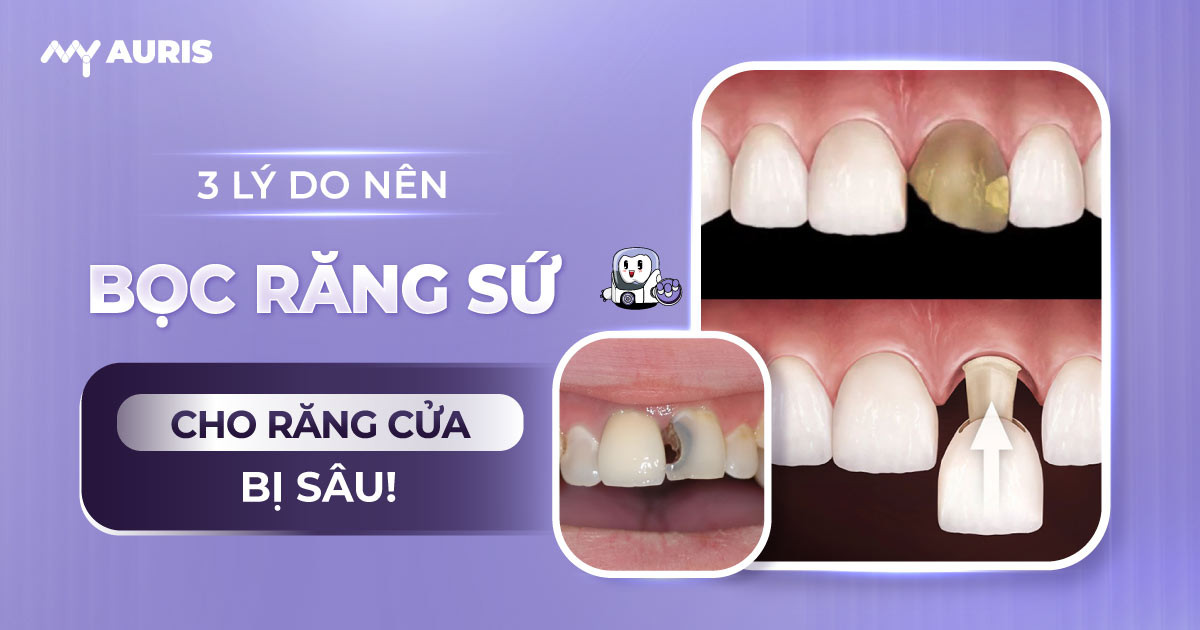 bọc răng sứ cho răng cửa bị sâu