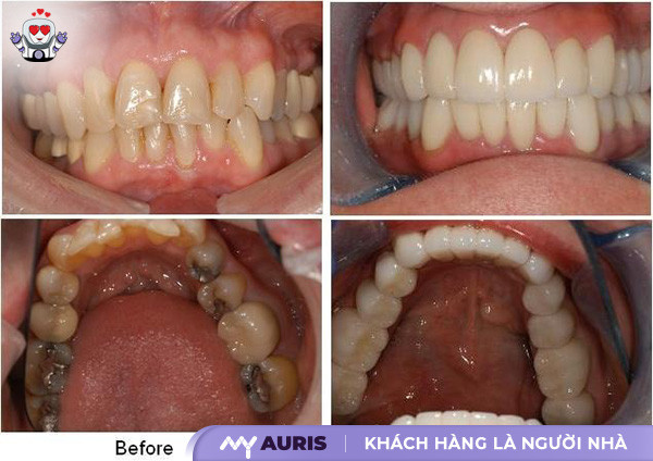 bọc sứ răng số 7 bao nhiêu tiền,bọc sứ răng số 7