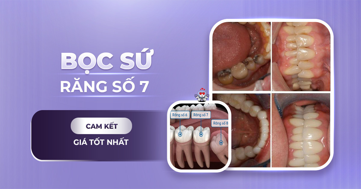 bọc sứ răng số 7 bao nhiêu tiền,bọc sứ răng số 7