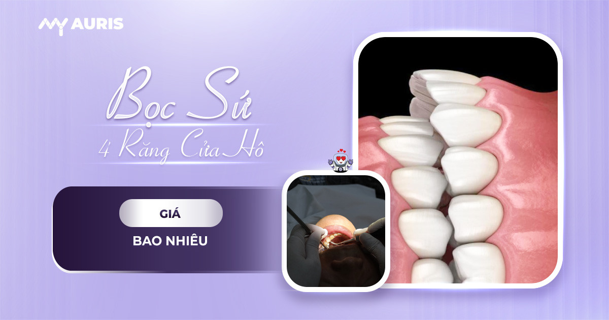 bọc răng sứ cho 4 răng cửa bị hô