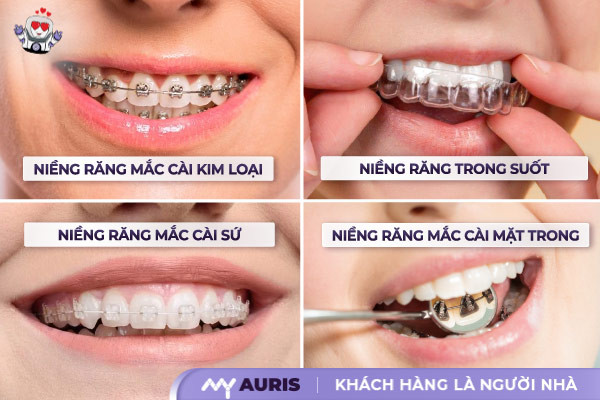 niềng răng hô thành công