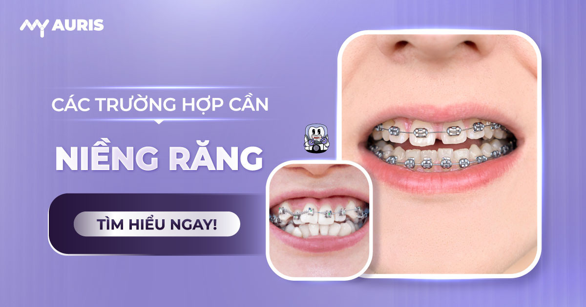 các trường hợp cần niềng răng